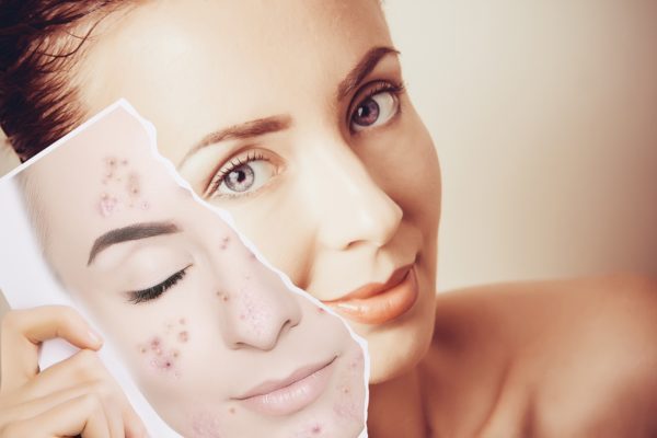 Acne-Free Skin