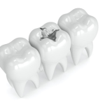 Fort Worth Dental Implants